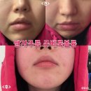 또팔자 | 명동피부과에서 필러 대신 쥬베룩볼륨으로 팔자주름 관리하기