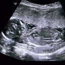 컴사바 | [공지] 2차 기형아 검사 통과! 임신4개월차 배크기와 입덧증상기록✌🏻