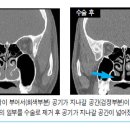 봄의 불청객 알레르기 비염에 대하여 - 아주대병원 이비인후과 김현준 교수님 이미지