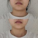 구미에스테틱 더벨뷰티앤에스테틱 RF관리