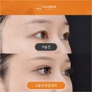 희소성형외과의원 | 대전성형외과 희소 재수술 없이 한 번에 끝내고 싶은 분들의 선택