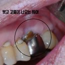 서울미치과 | 달서구 임플란트 치과 붓고 고름이 나오는 어금니, 녹아내린 잇몸뼈 임플란트