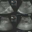 Lt. renal cyst 이미지