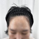 자연스러운 전문가 SMP시술 "콤마더문 명동" 헤어라인 교정 후기.