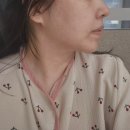 당신만의가치벨유의원 | 명동역피부과 슈링크 유니버스 300샷 후기^^