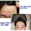 부산 화명동 피부과 추천 비립종제거 솔직후기, 비립종 원인과 관리방법도 함께:&gt;