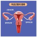 CU 신기부은점 | 송파 민트병원 장막하근종 자궁근종색전술 2박3일 입원 일상~