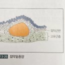 호산육종 이미지