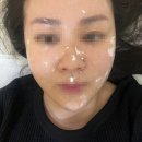 리디아여성의원 | [어븀야그레이저] 리디아여성의원 어븀야그 편평사마귀 제거후기