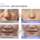 유니앤코어 더마10으로 바뀐 피부, Before &amp; After 이야기