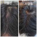 제이케이두피부띠크(JK두피부띠크) | 광주 제이케이두피부띠크 SMP 두피채우기 찐후기