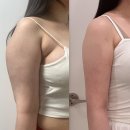 팔센치 | 팔뚝 지방추출주사 3주차 후기｜팔둘레 5.5cm 감소, 붓기 멍 변화