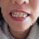 아껴주는치과그룹 | 치아미백 고민이라면? 자가 미백 vs 치과 미백 비교 + 실제 후기