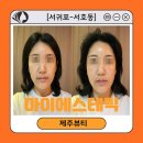 서호동-3 | [서귀포-서호동] 서귀포윤곽관리 &#39;마이에스테틱&#39; 작은얼굴 전후비교