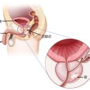 '순한 암'이라고? 증상 나타나면 이미 3기…韓남성 발병 늘었다 이미지