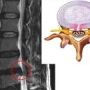 허리디스크 VS 척추관협착증 이미지