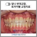 서울미소담은치과의원 | [건대 교정치과] 앞니 반대교합 &amp; 토끼이빨 치아교정 9개월(리얼 후기 포함)