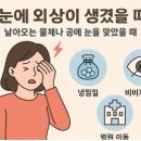 공콘택트렌즈 | 날아오는 물체나 공에 눈을 맞았을 때, 눈에 외상이 생겼을때 주요 증상 및 응급처치, 치료방법