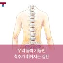 허리측만증교정기 정밀 검사 후 맞춤 보조기 착용