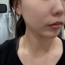 쿨페이즈리프팅 600샷 아우라엘의원 후기