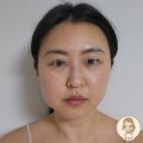 케이톡스의원 인천구월점 | [부평] 케이톡스 피부과 울쎄라 300샷, 보톡스, 케슬톡스, 제모 생생후기 내돈내산(총 2번 방문)