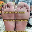 지간신경종 족저근막염 무지외반증 발바닥통증의 공통점-손태석 발가락운동용구 이미지