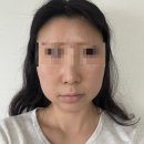 라인A여자경로당 | 볼살부자가 슈링크 인모드 맞은 솔직후기 비포애프터있음 (내돈내산 광고 절대아님)