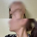원주신부케어 관리 1회만으로도 이중턱 삭제되는 안녕예쁜아 도아에스테틱 에어부스터 후기