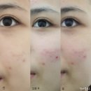CU 거제옥포조은점 | 피부관리 반하다에스테틱 피글 에르모듀로 해결했어요