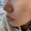 예스피부과의원 | [인천] 영종도 운서역 피부과 포텐자+쥬베룩 3cc 후기