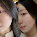 모델로피부과의원 | 강남구청피부과, 줄기세포 스킨부스터 효과 및 솔직후기 (이노벨의원)