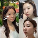디웨이브(주) | 쥬베룩볼륨 대신 힐로웨이브 옆볼 눈밑 일주일 경과 후기 강남역 피부과
