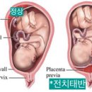 전치 앞(2) 이미지