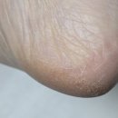 영진약국 | 가성비 풋크림 아케이 더마 리치리치 각질 크림 후기