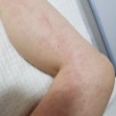 고운그대한의원 | 두드러기 혈관염 (기록용1)
