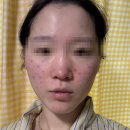 분당우태하피부과의원 | [피부과] 유픽의원 강남점 | 스킨보톡스 4cc 풀페이스 내돈내산 솔직 후기! (단점 포함)