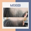 하남 미사 M자탈모 이마라인커버로 자신감 되찾기
