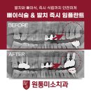 강원 인제군 임플란트 치과 비용 정보, 치료비 70%까지 정부지원금 받는 방법