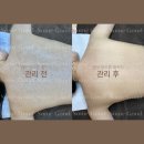 모공각화증 약초필링 등필링 부작용 부산 썸굿 해결 후기