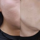 고려한의원 | 노원한의원추천 중계동 피부과 패인흉터 새살침 후기(4회차)