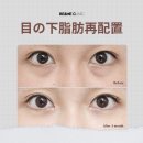 티제이성형외과의원 | 눈밑지방재배치 잘하는 병원 추천! 서울·강남 TOP 10 총정리