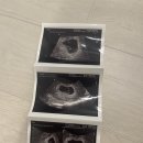 한빛산부인과의원 | 임신 6주 난황 초음파 확인, 첫 심장소리 확인 후기 | 임신일기#4