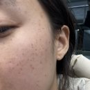 31140-6-73-23 | [내돈내산 후기] 미금역 피부과 유어라인의원 편평사마귀 무제한 제거/듀오덤x, 마취크림x