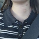 대림성모병원 | [대림성모병원 갑상선] 갑상선 초음파 / 진료후기 (성진용 교수)