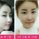 에스탑성형피부 네이버블로그