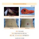 만성담낭염수술후기. 유튜브에서 원장님 동영상 찾아보고 친절하고 상세하게 안내해 주시고 복강경수술 많이 하셨다는... 이미지