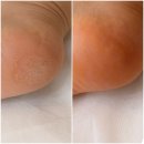 레푸스 영통점 | 수원 발각질 레푸스 영통점 발각질 케어 후기 | 굳은살 관리 다녀온 기록