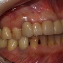 미소가있는보스톤치과의원 | 경기광주태전동치과 자연치아 보존 &amp; 임플란트, 치과공포증 이겨내고 되찾은 환한 미소