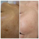 송산그린시티 | 화성여드름관리 송산그린시티 피부관리 후기로 밝아진 나의 피부