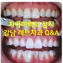 최.박치과의원 | 강남 치아미백 성지 레브치과. 가격/비용/부작용/전후사진.